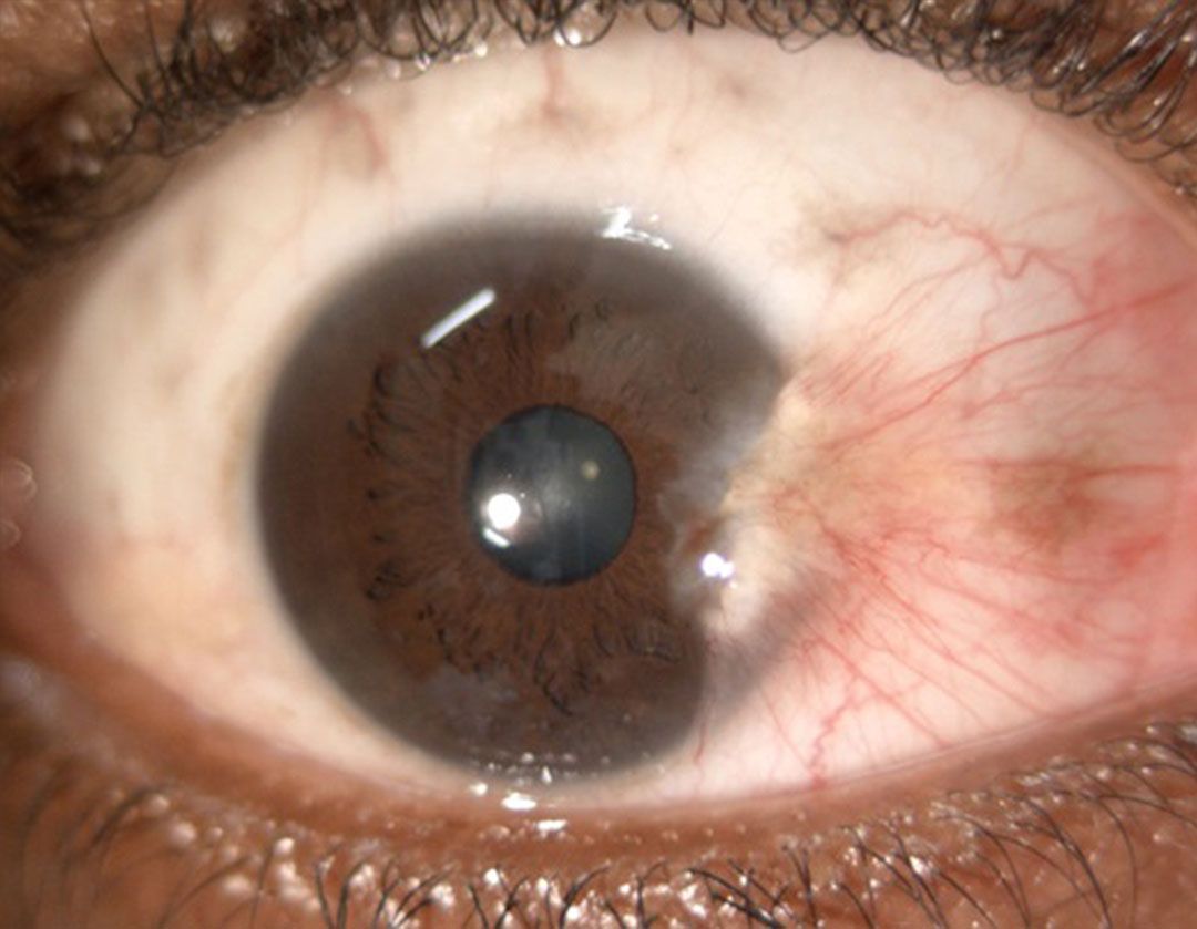 What is Pterygium? | Symptoms & Causes | Mr Amit Patel